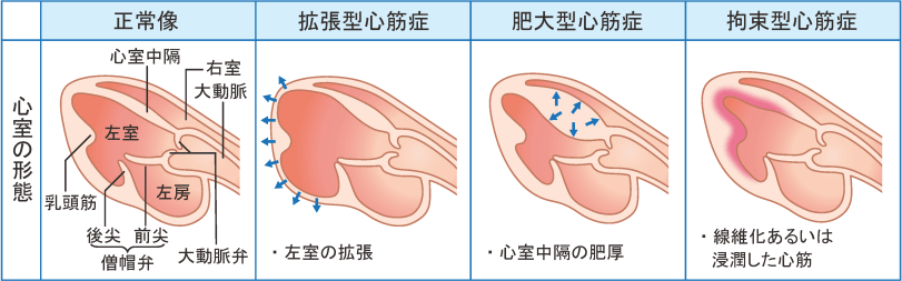 心筋症とは（DCM、HCM、RCM） | 心不全がよくわかる 心不全.com | 日本メドトロニック株式会社